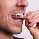 clear-aligners-market