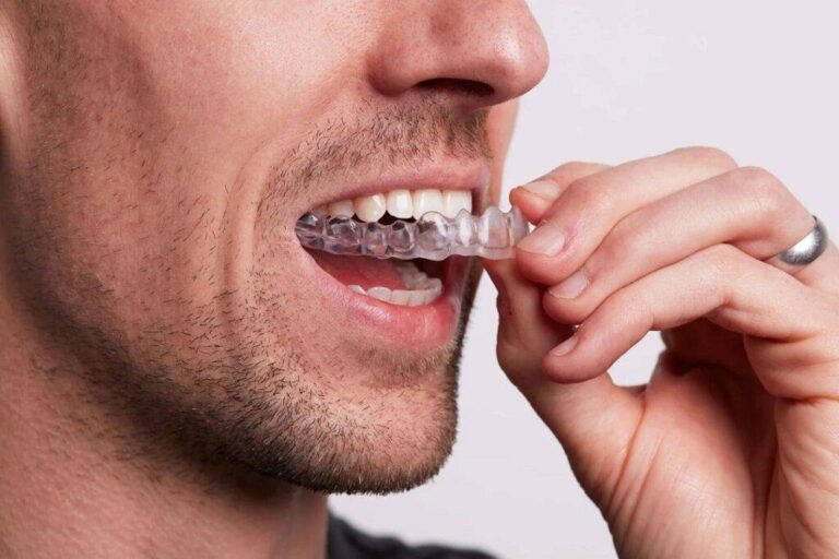 clear-aligners-market